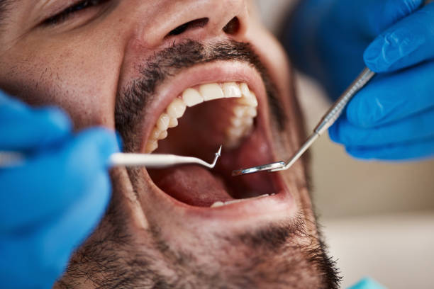 Best Emergency Care for Gum Disease in Mason City, IA